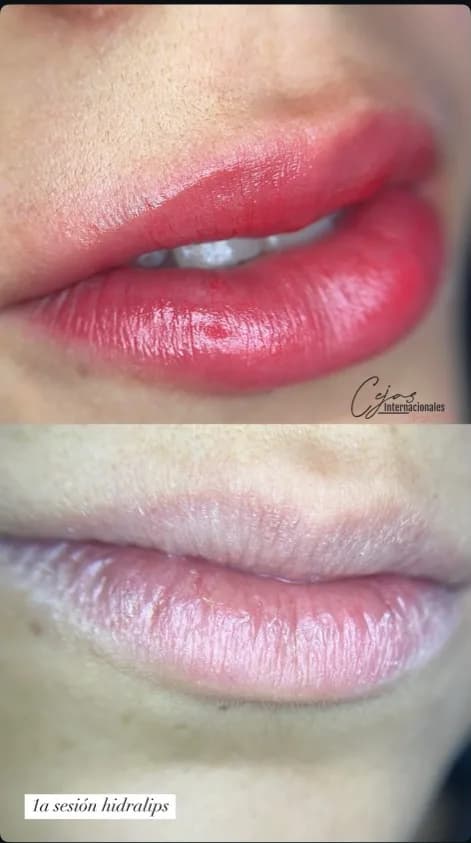 Antes y después de la primera sesión de HidraLips con labios hidratados
